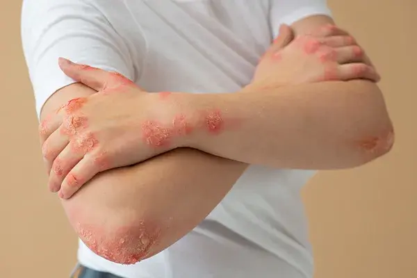 آلرژی پوستی